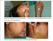 Before After Pictures,Cosmetic surgery,Delhi,endoscopic lipoma,sebacious cyst